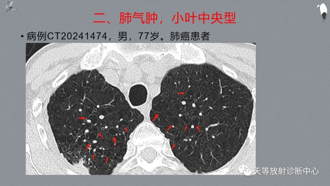 正常吸气及呼气HRCT表现—探索小叶性含气增多影像学-31