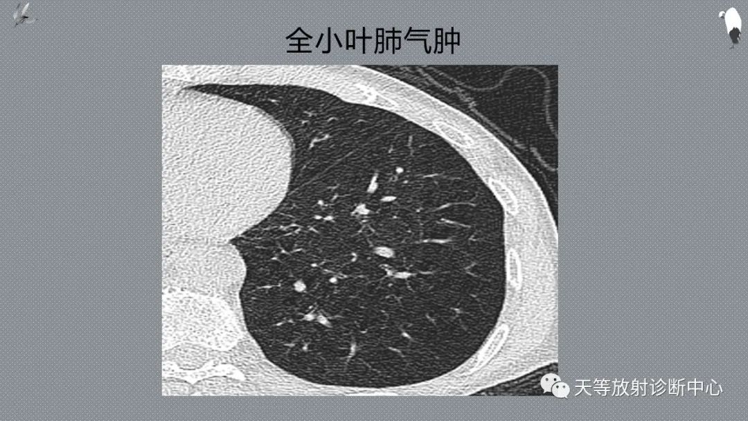 正常吸气及呼气HRCT表现—探索小叶性含气增多影像学-32