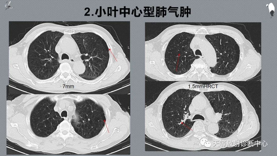 正常吸气及呼气HRCT表现—探索小叶性含气增多影像学-35