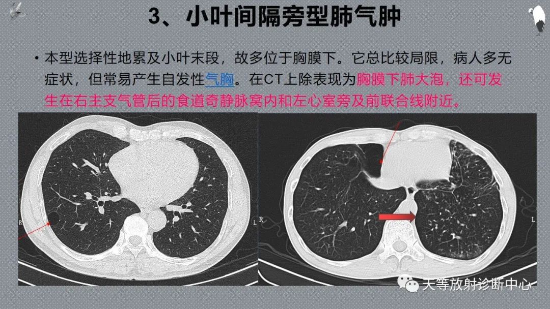 正常吸气及呼气HRCT表现—探索小叶性含气增多影像学-36