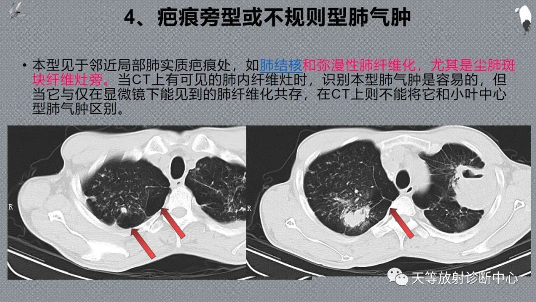 正常吸气及呼气HRCT表现—探索小叶性含气增多影像学-37