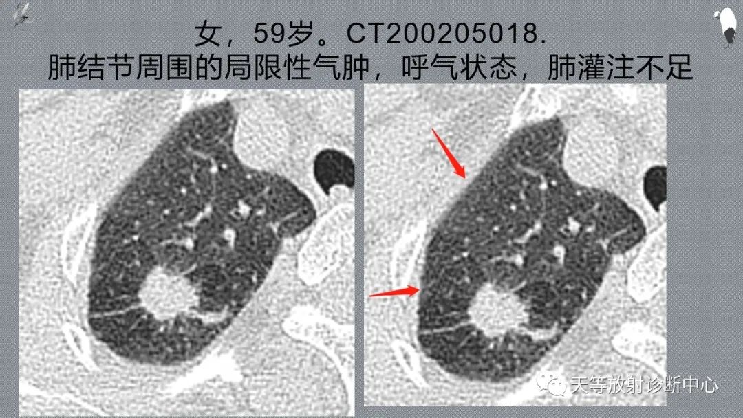 正常吸气及呼气HRCT表现—探索小叶性含气增多影像学-38