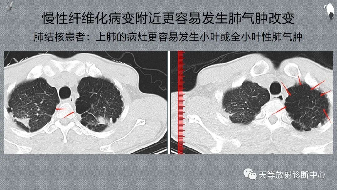正常吸气及呼气HRCT表现—探索小叶性含气增多影像学-39
