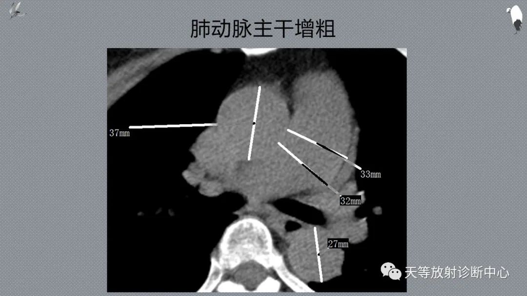 正常吸气及呼气HRCT表现—探索小叶性含气增多影像学-1
