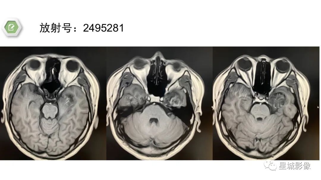 【病例】颅内成熟性囊性畸胎瘤1例MR影像表现-4