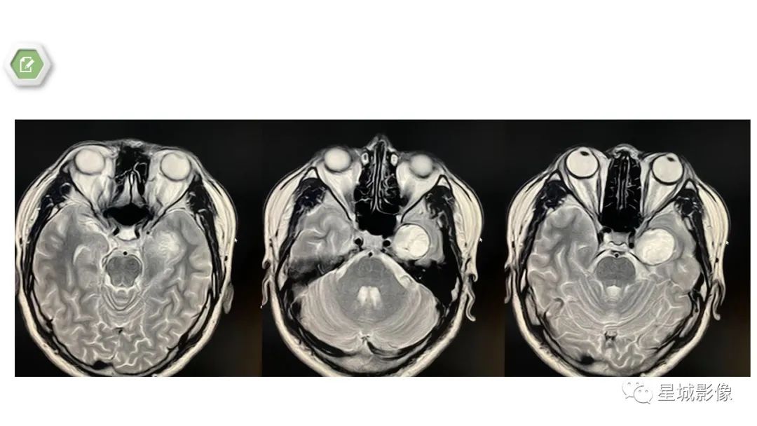 【病例】颅内成熟性囊性畸胎瘤1例MR影像表现-5
