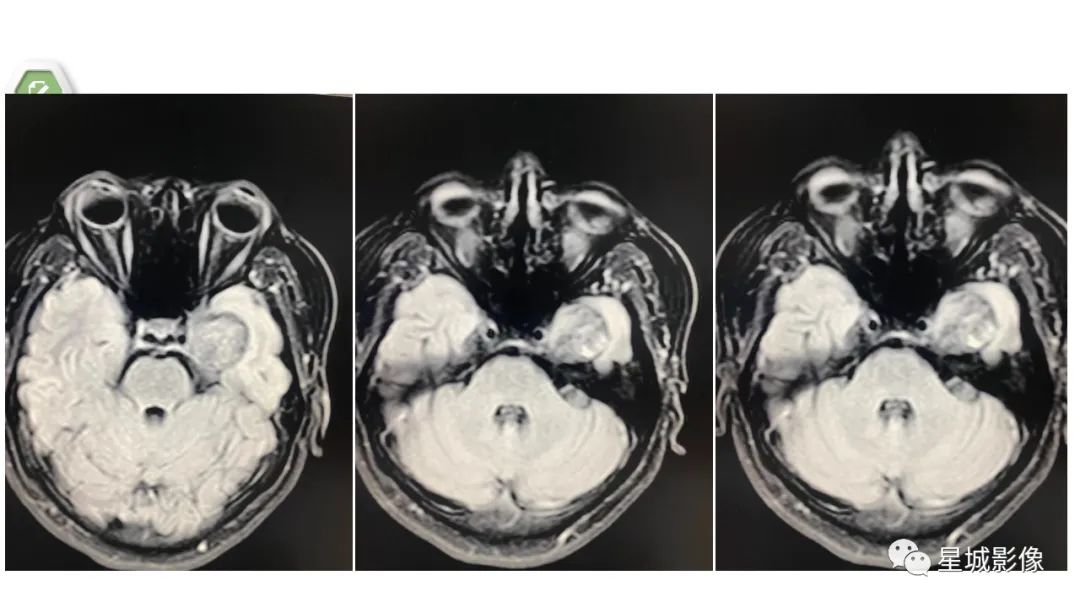 【病例】颅内成熟性囊性畸胎瘤1例MR影像表现-6