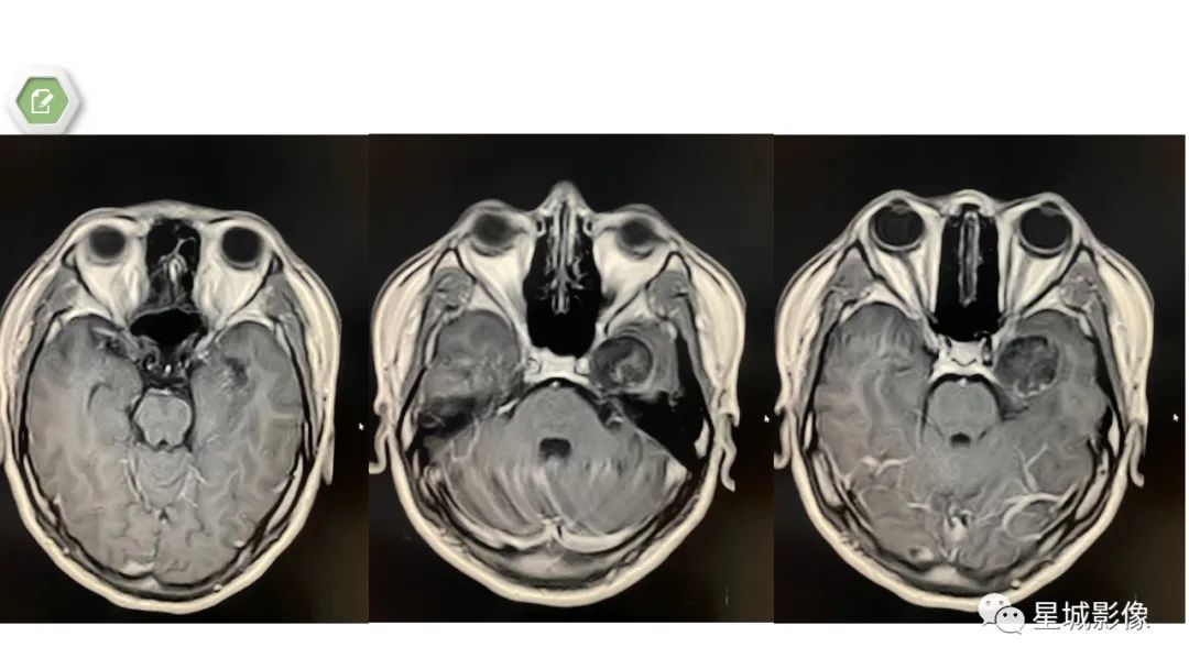 【病例】颅内成熟性囊性畸胎瘤1例MR影像表现-7