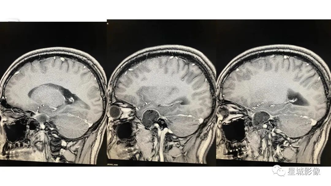 【病例】颅内成熟性囊性畸胎瘤1例MR影像表现-8