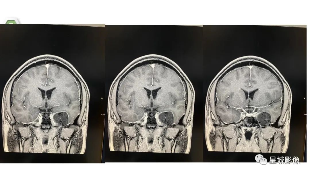 【病例】颅内成熟性囊性畸胎瘤1例MR影像表现-9