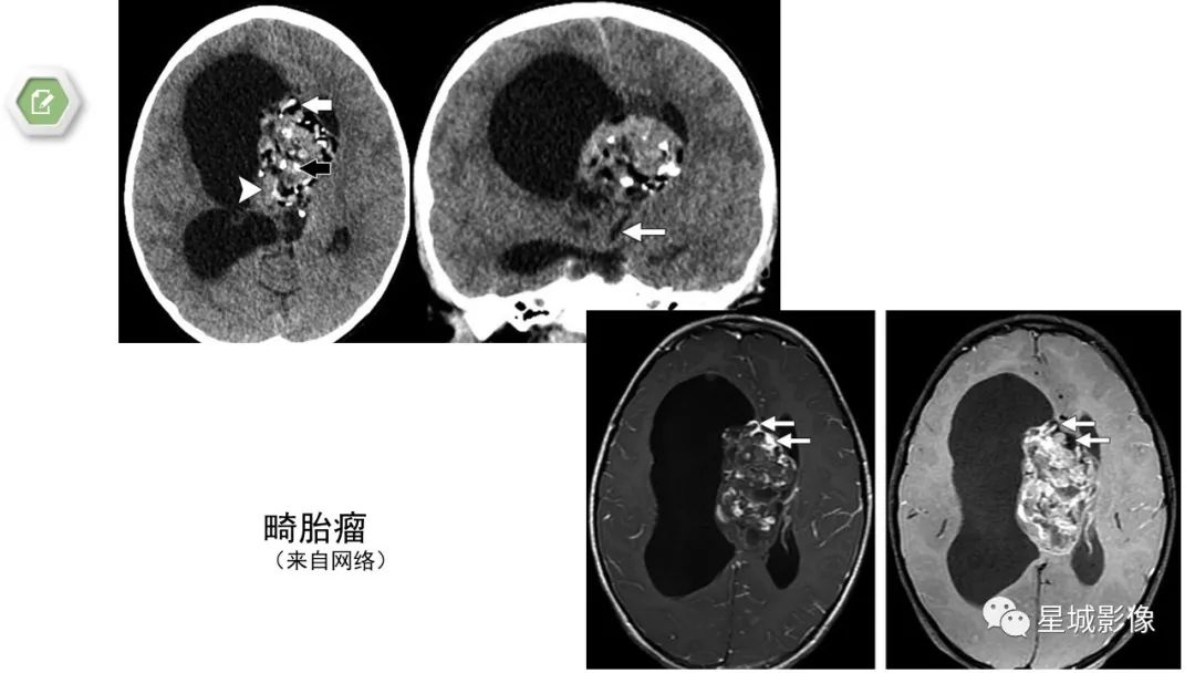 【病例】颅内成熟性囊性畸胎瘤1例MR影像表现-15