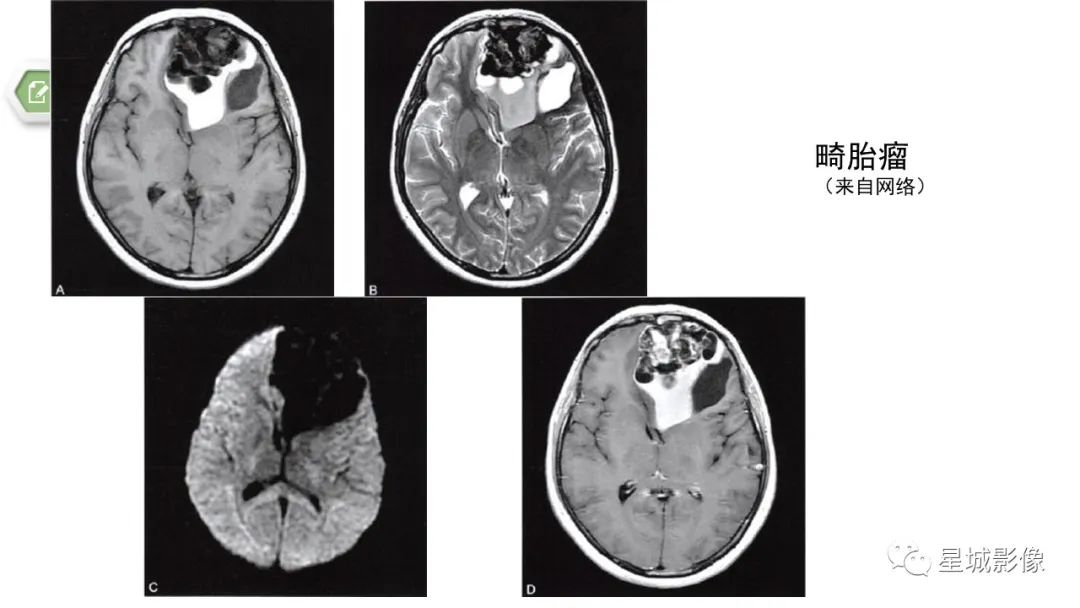 【病例】颅内成熟性囊性畸胎瘤1例MR影像表现-16