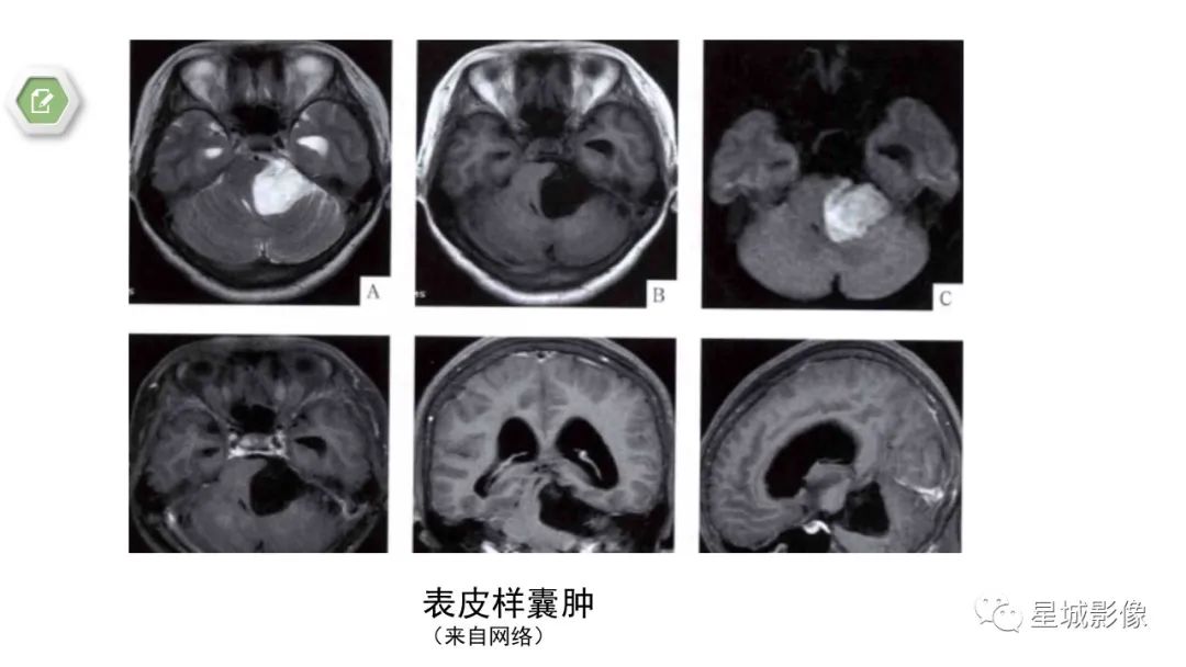 【病例】颅内成熟性囊性畸胎瘤1例MR影像表现-18