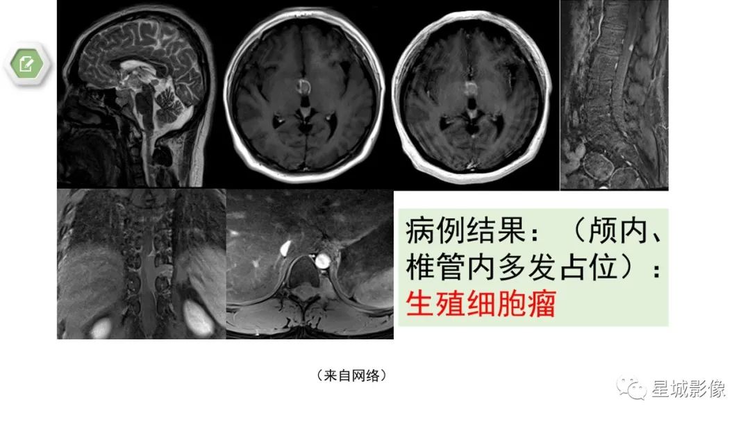 【病例】颅内成熟性囊性畸胎瘤1例MR影像表现-19