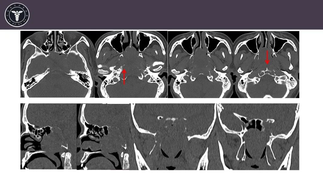 【病例】斜坡区骨巨细胞瘤 VS 脊索瘤-4