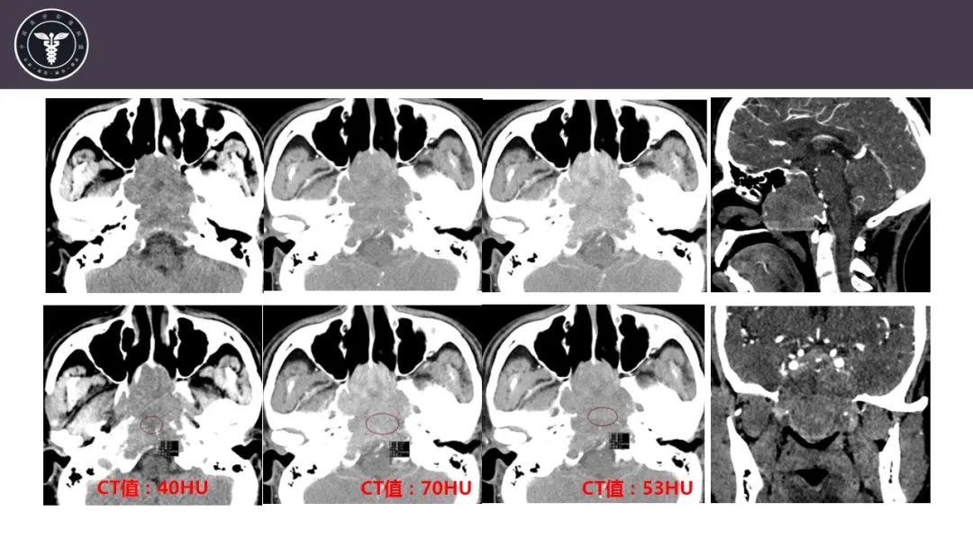 【病例】斜坡区骨巨细胞瘤 VS 脊索瘤-3
