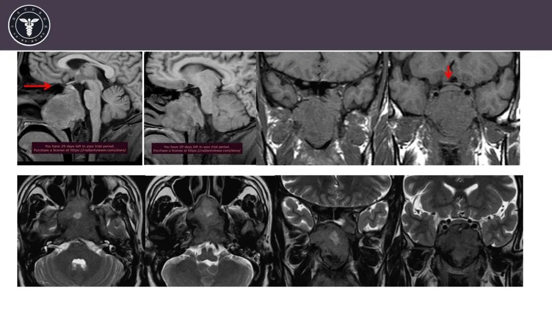 【病例】斜坡区骨巨细胞瘤 VS 脊索瘤-5