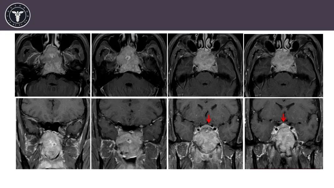 【病例】斜坡区骨巨细胞瘤 VS 脊索瘤-6