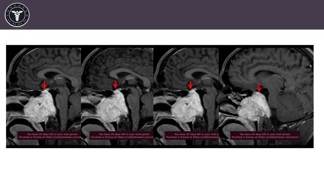 【病例】斜坡区骨巨细胞瘤 VS 脊索瘤-7