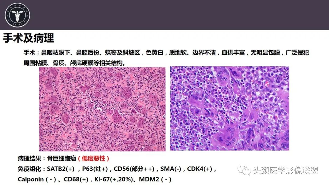 【病例】斜坡区骨巨细胞瘤 VS 脊索瘤-9