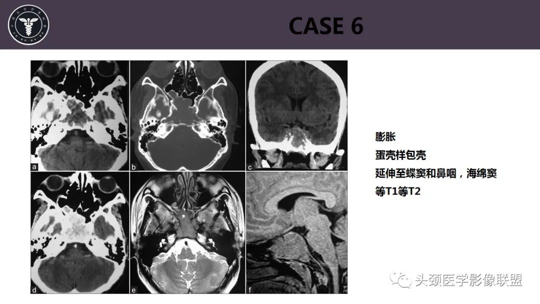 【病例】斜坡区骨巨细胞瘤 VS 脊索瘤-13