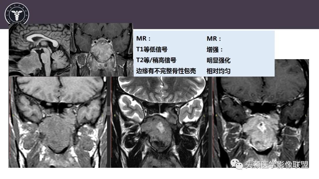 【病例】斜坡区骨巨细胞瘤 VS 脊索瘤-12