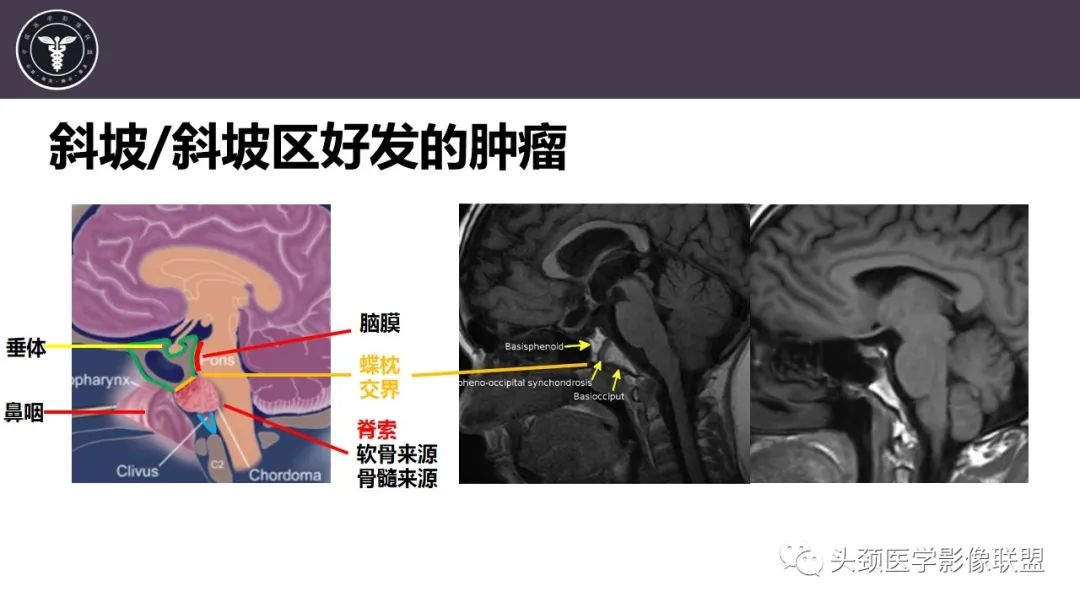 【病例】斜坡区骨巨细胞瘤 VS 脊索瘤-14