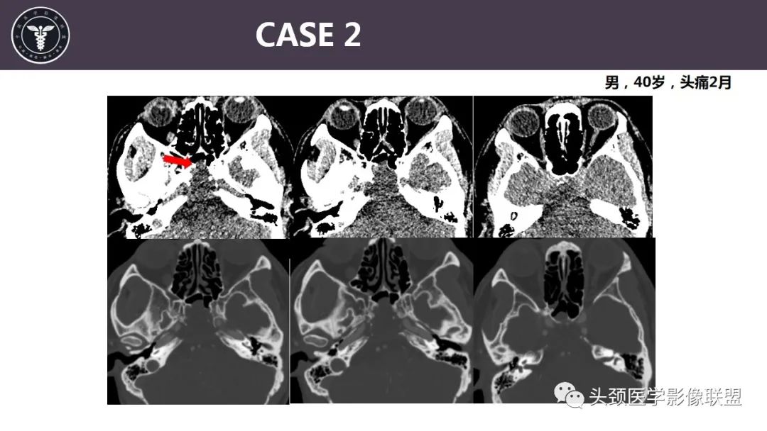 【病例】斜坡区骨巨细胞瘤 VS 脊索瘤-16