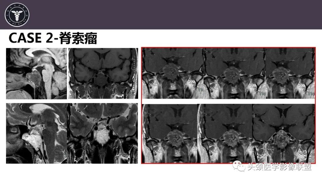 【病例】斜坡区骨巨细胞瘤 VS 脊索瘤-17