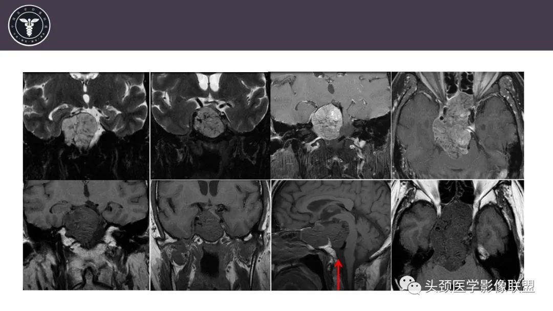 【病例】斜坡区骨巨细胞瘤 VS 脊索瘤-18
