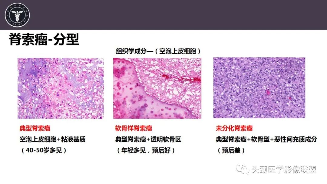 【病例】斜坡区骨巨细胞瘤 VS 脊索瘤-20