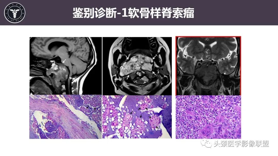 【病例】斜坡区骨巨细胞瘤 VS 脊索瘤-22