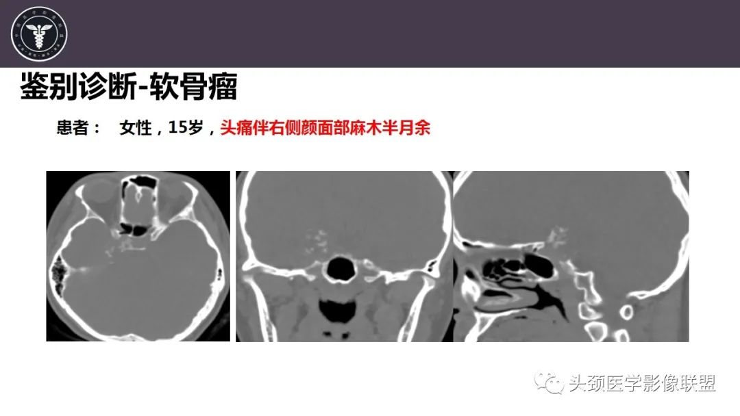 【病例】斜坡区骨巨细胞瘤 VS 脊索瘤-23