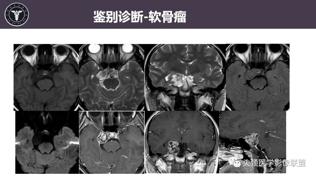 【病例】斜坡区骨巨细胞瘤 VS 脊索瘤-24