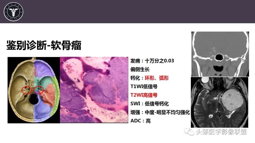 【病例】斜坡区骨巨细胞瘤 VS 脊索瘤-25