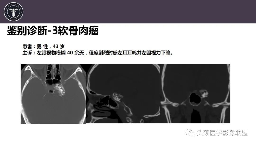 【病例】斜坡区骨巨细胞瘤 VS 脊索瘤-26