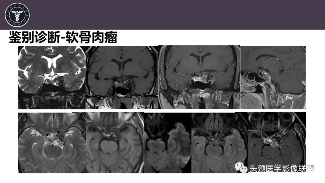 【病例】斜坡区骨巨细胞瘤 VS 脊索瘤-27