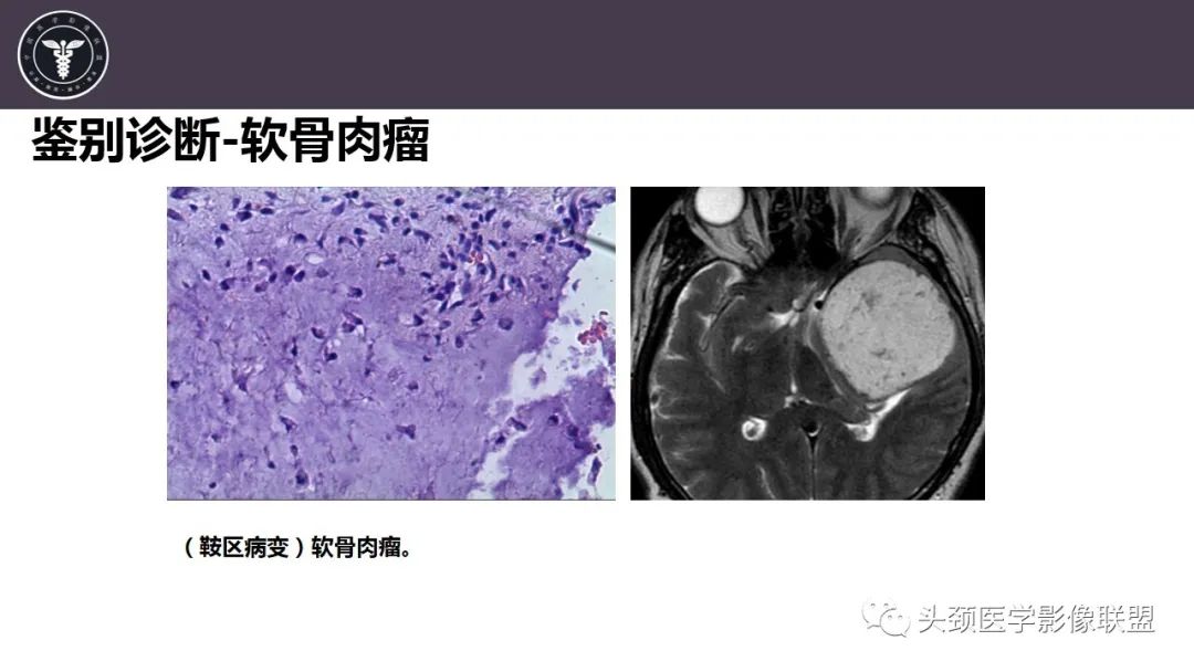 【病例】斜坡区骨巨细胞瘤 VS 脊索瘤-28