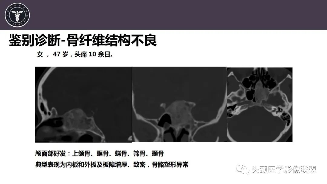 【病例】斜坡区骨巨细胞瘤 VS 脊索瘤-29