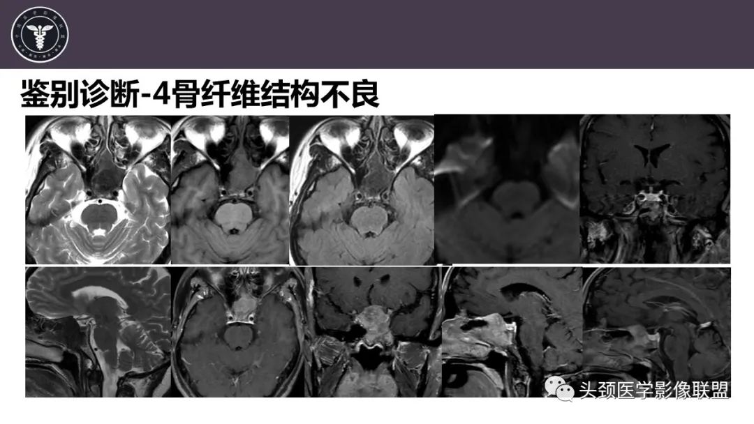 【病例】斜坡区骨巨细胞瘤 VS 脊索瘤-30