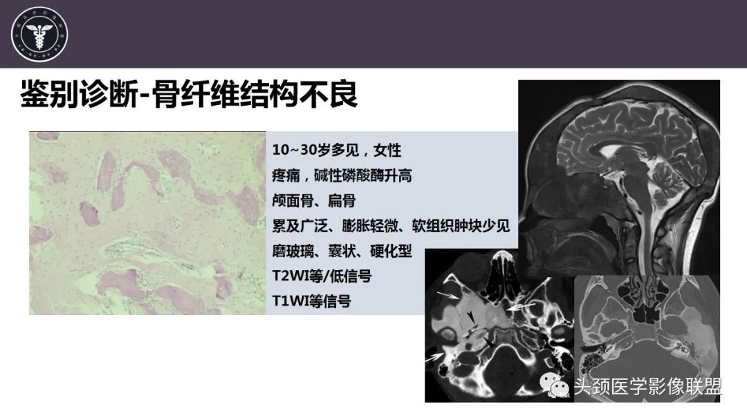 【病例】斜坡区骨巨细胞瘤 VS 脊索瘤-31