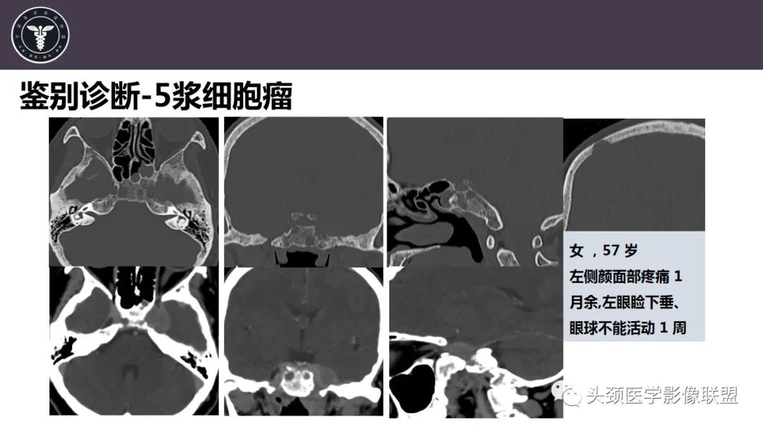 【病例】斜坡区骨巨细胞瘤 VS 脊索瘤-32