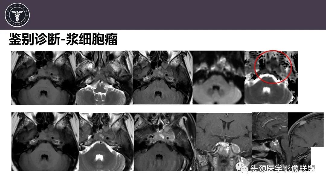 【病例】斜坡区骨巨细胞瘤 VS 脊索瘤-33