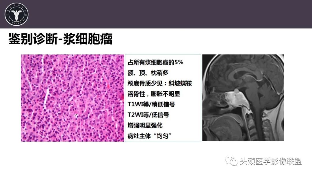 【病例】斜坡区骨巨细胞瘤 VS 脊索瘤-34