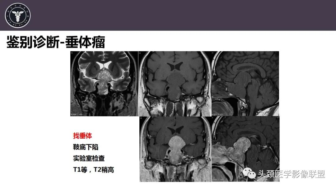 【病例】斜坡区骨巨细胞瘤 VS 脊索瘤-35