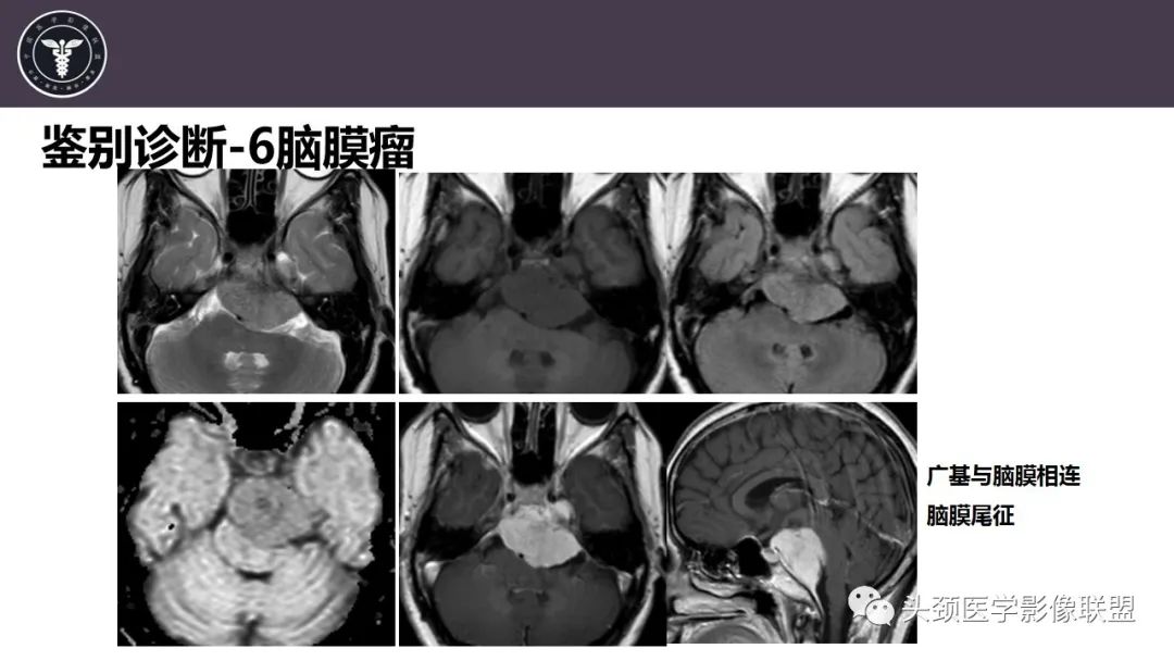 【病例】斜坡区骨巨细胞瘤 VS 脊索瘤-36