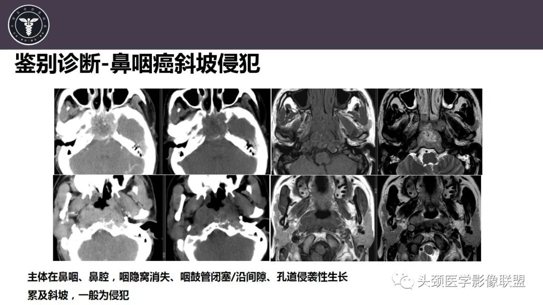 【病例】斜坡区骨巨细胞瘤 VS 脊索瘤-37