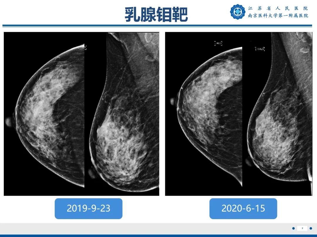 【PPT】导管原位癌-3
