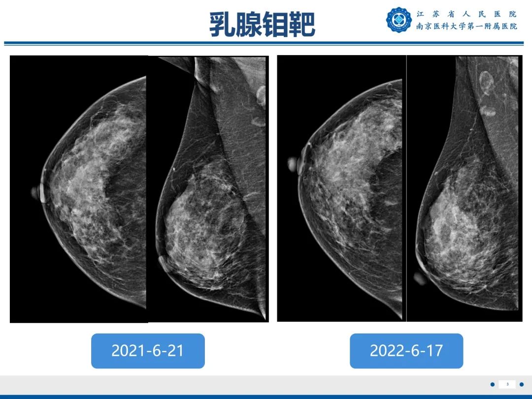 【PPT】导管原位癌-4