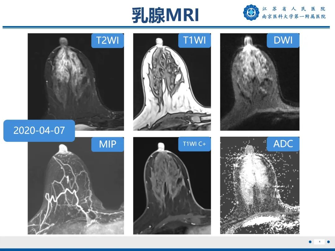 【PPT】导管原位癌-5